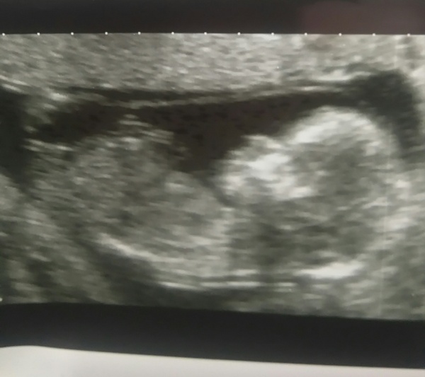 September 2016 (Thread 2) Booking in and 12 weeks scans soon!