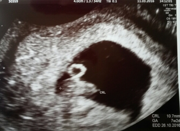 TTC through Donor IUI or Donor IVF or just undecided - all welcome!