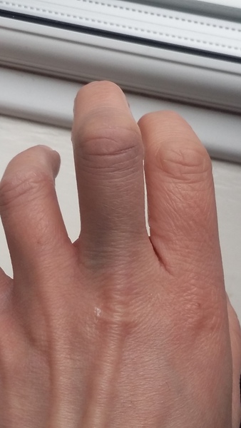 Has anyone had a lupus coagulant test