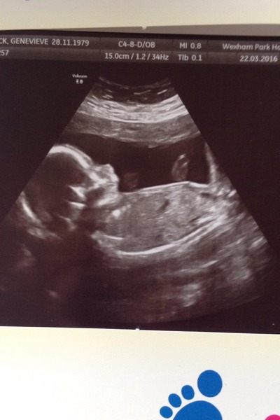 August 2016 number 4 - bumps popping and scans happening, we actually have babies!