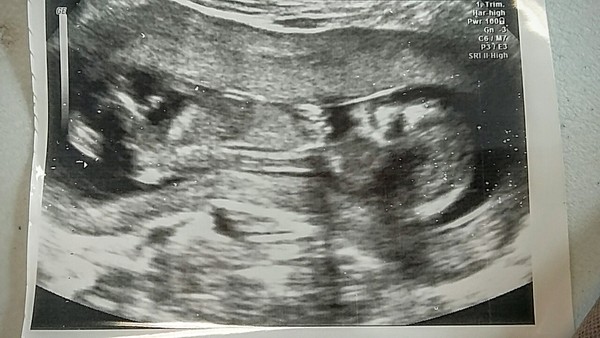 September 2016 (Thread 2) Booking in and 12 weeks scans soon!