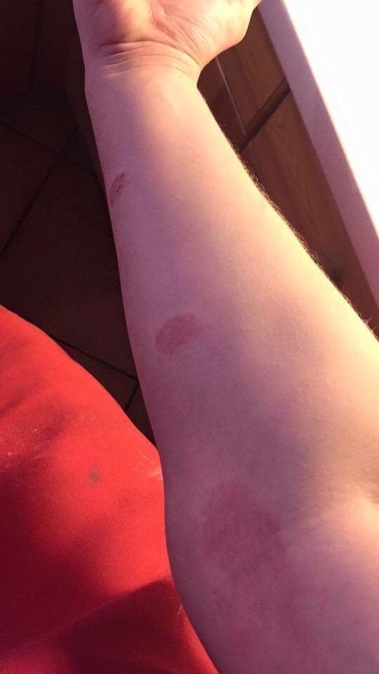 anyone like to diagnose DS's rash please. pic included.