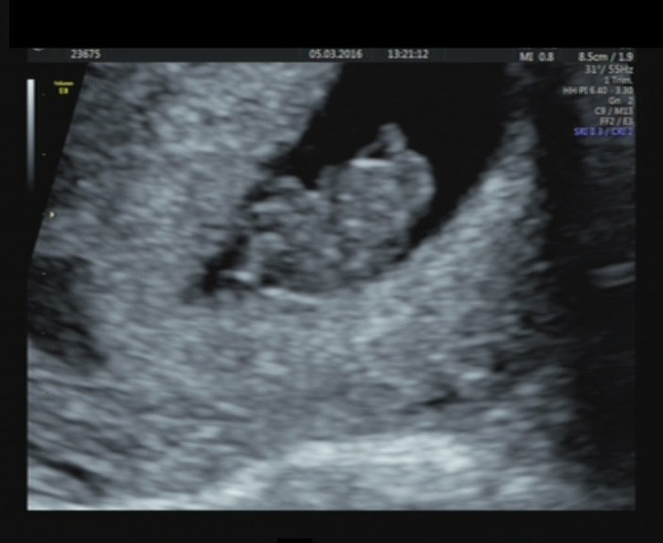 Pregnancy after infertility