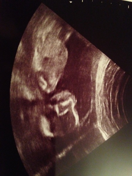 Pregnancy after infertility