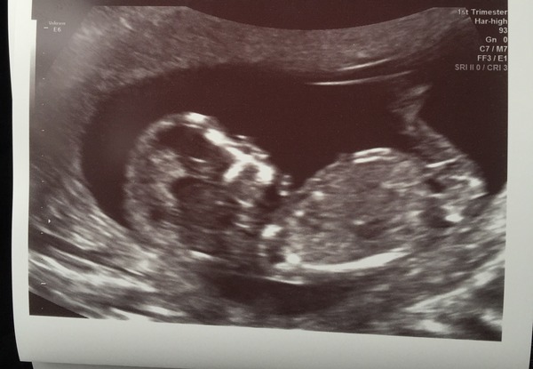 September 2016 (Thread 2) Booking in and 12 weeks scans soon!