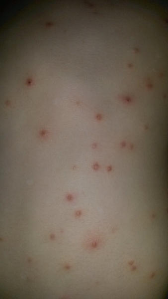 eczema or allergy? Please have a look at this pic.