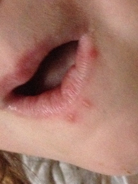 Spots around mouth - HF&M?