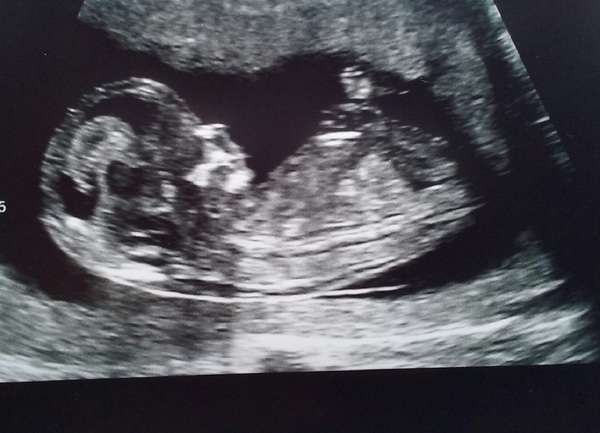 Pregnancy after infertility