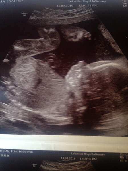 August 2016 number 4 - bumps popping and scans happening, we actually have babies!