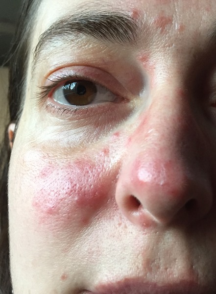 Could this be rosacea?