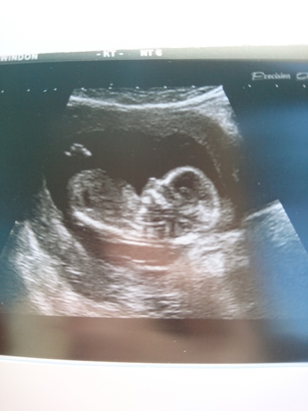 September 2016 (Thread 2) Booking in and 12 weeks scans soon!