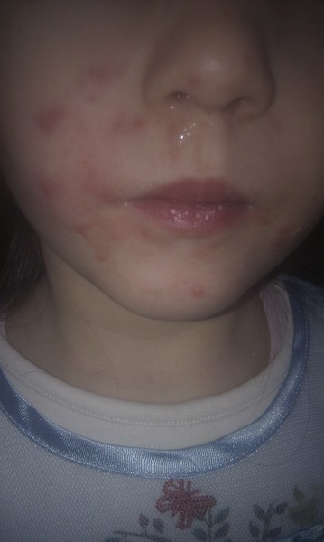 4yo facial rash following fever - not chickenpox or hand/foot/mouth - any ideas?
