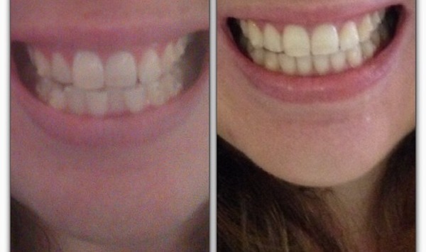 Has anyone had their teeth straightened with braces or those gum shield things?