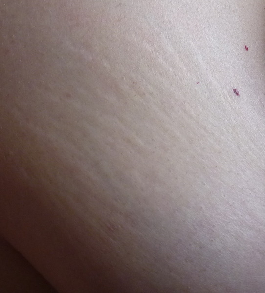 Breast dimpling