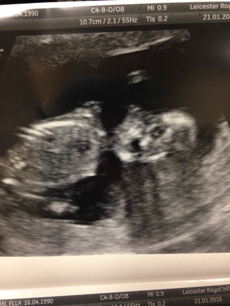 did anyone else's 12 week scan look a little strange?!