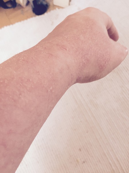 At end of my tether - eczema and stupidly itchy dry skin - HELP!