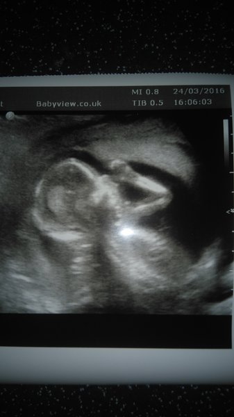 September 2016 (Thread 2) Booking in and 12 weeks scans soon!