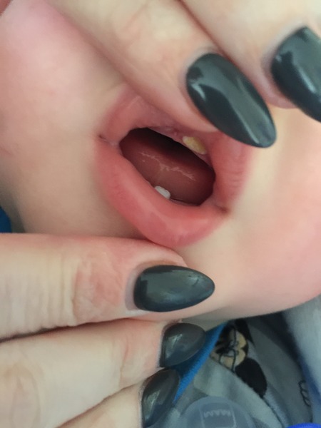 baby has yellow tooth