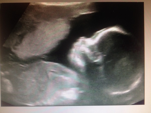 August 2016 number 4 - bumps popping and scans happening, we actually have babies!