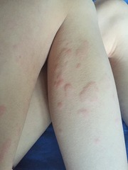 Odd rash on legs - photos included