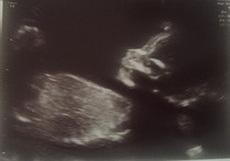 August 2016 number 4 - bumps popping and scans happening, we actually have babies!