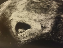 Pregnancy after infertility