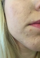 Advice for those with acne with pics