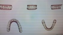 Has anyone had their teeth straightened with braces or those gum shield things?