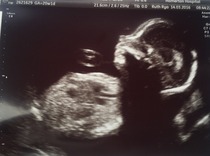 August 2016 number 4 - bumps popping and scans happening, we actually have babies!