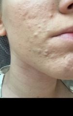 Advice for those with acne with pics