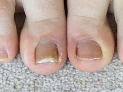 Why is my toenail like this? (Warning: photos.  Though not particularly ewww.)