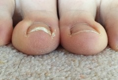 Why is my toenail like this? (Warning: photos.  Though not particularly ewww.)