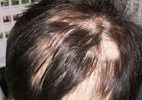 Alopecia Areata - Anyone have any experience? 10 yo DS