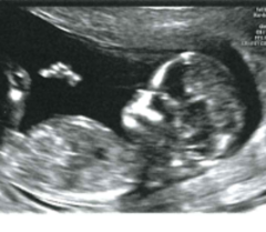 Pregnancy after infertility