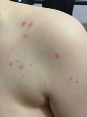 Possibly the start of Chicken pox?