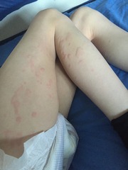Odd rash on legs - photos included