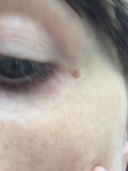Hyperpigmentation on face - what to do?!