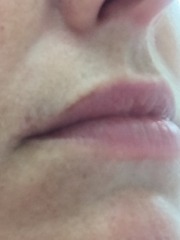 Hyperpigmentation on face - what to do?!