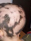 Alopecia Areata - Anyone have any experience? 10 yo DS