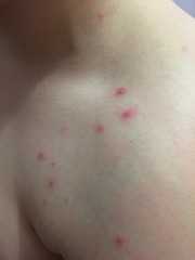 Possibly the start of Chicken pox?