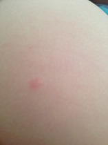 Spots like chickenpox but not chicken pox??