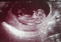 Pregnancy after infertility