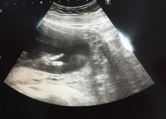 August 2016 number 4 - bumps popping and scans happening, we actually have babies!