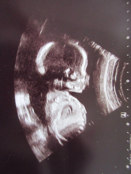 August 2016 number 4 - bumps popping and scans happening, we actually have babies!