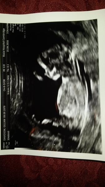 TTC through Donor IUI or Donor IVF or just undecided - all welcome!