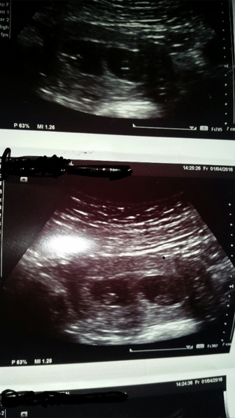 Would you be my Infertility/Clomid/Follicle tracking friend please?!