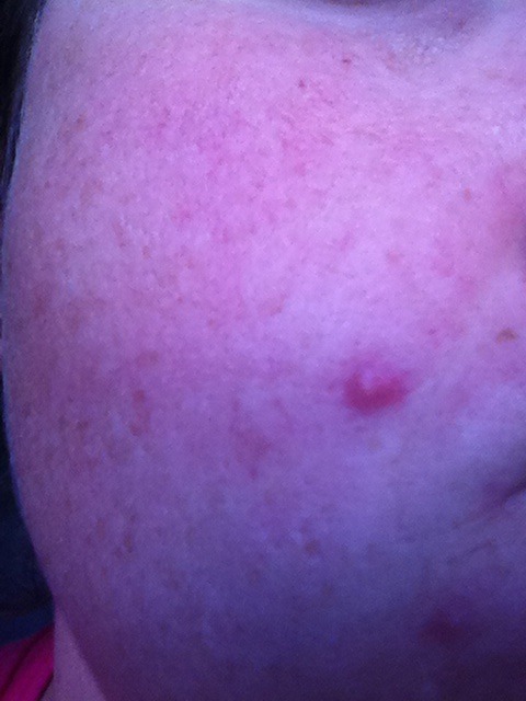 help me get rid of a lump