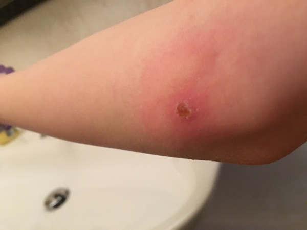 painful arm eek