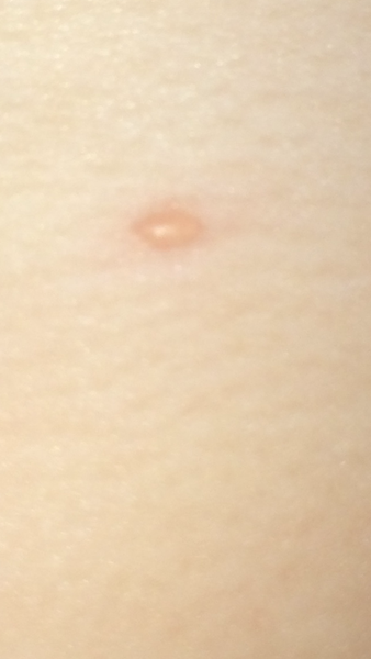 Chicken Pox??