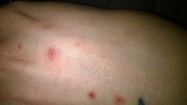 Could this be skin cancer? Or am I a hypochondriac?